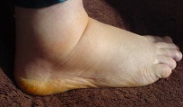 Diminuez l'enflure au pied après une chirurgie ou blessure au pied ...