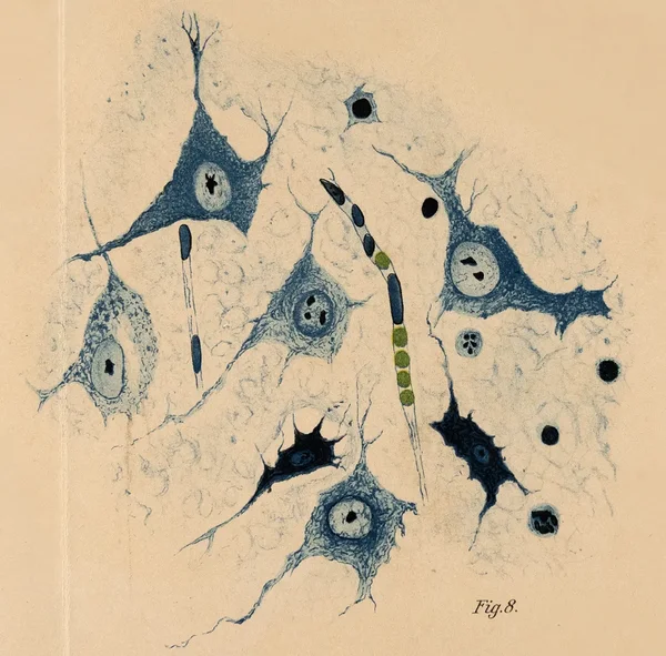 Fig. 8 aus der Habilitationsschrift: Grosse geschwollene Ganglienzellen aus der Tiefe des replantirten Stückes 8 Stunden nach der Operation (Versuch 2). Vergr. 1000. Färbung nach Nissl. Unten zwei geschrumpfte Ganglienzellen, links eine mit Vacuolisirung des Protoplasmas. (Originalschreibweise)	 Archiv für Psychiatrie Bd. 40 (1905) 